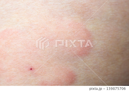 Skin allergy rash dermatitis texture close up background 139875706