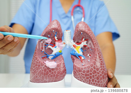 Pneumonia, lung cancer, Asian doctor with human lung model. Pneumonia, lung cancer, Asian doctor with human lung model. 139880878
