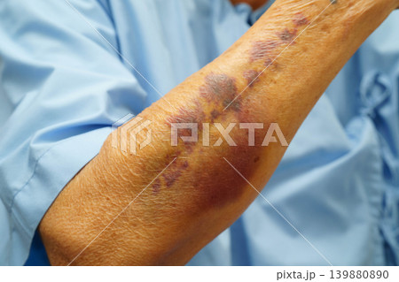Ecchymosis, elderly bleeding on her arm after taking aspirin. 139880890