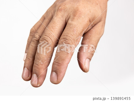 Skin peeling due to an allergic reaction. Skin peeling due to an allergic reaction. 139891455