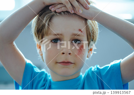 Portrait of a child with scratches after fall on his face Portrait of a child with scratches after fall on his face 139913567