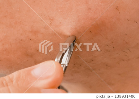 Close-up of plucking unwanted hair from skin on the chin. A daily home beauty care routine for face epilation and removal of hormonal mustache or facial hair. 139931400