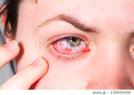 Conjunctivitis making eye bloodshot and swollen. Patient at ophthalmology clinic. Doctor using slit lamp for diagnosis. Eye infection treatment with antibacterial drops 139934406