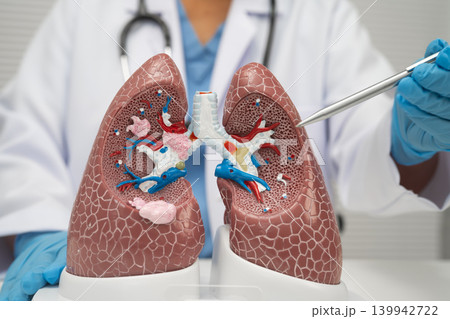 Pneumonia, lung cancer, Asian doctor with human lung model. 139942722