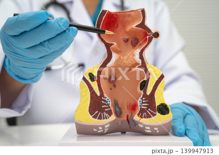 Asian doctor with rectum and hemorrhoid human model, inflamed vascular structure. Asian doctor with rectum and hemorrhoid human model, inflamed vascular structure. 139947913