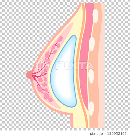 矽膠假體隆乳:隆乳手術結構(腺體下植入法) 矽膠假體隆乳:隆乳手術結構(腺體下植入法) 139952165