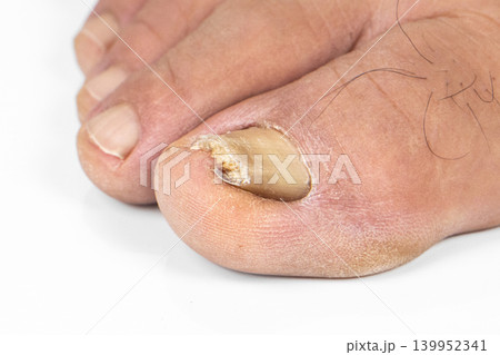 Ingrown toenail on a senior feet with white backgroundClose-up ingrown toenail on senior feet with white background. 139952341