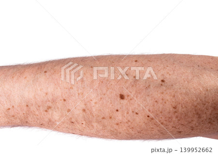 Human arm with multiple moles and freckles, skin cancer screening awareness concept 139952662