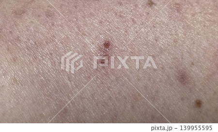 Close up macro of caucasian human skin with two small red healing scabs or insect bites, concept of minor dermatological problem and healthcare Close up macro of caucasian human skin with two small red healing scabs or insect bites, concept of minor dermatological problem and healthcare 139955595