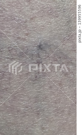 Close up macro of caucasian human skin showing visible purple spider veins and blood vessels network, concept of dermatological vascular healthcare Close up macro of caucasian human skin showing visible purple spider veins and blood vessels network, concept of dermatological vascular healthcare 139955596