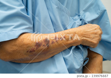 Ecchymosis, elderly bleeding on her arm after taking aspirin. Ecchymosis, elderly bleeding on her arm after taking aspirin. 139976887