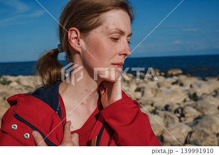 Portrait of a sad woman with chicken pox on the seashore Portrait of a sad woman with chicken pox on the seashore 139991910