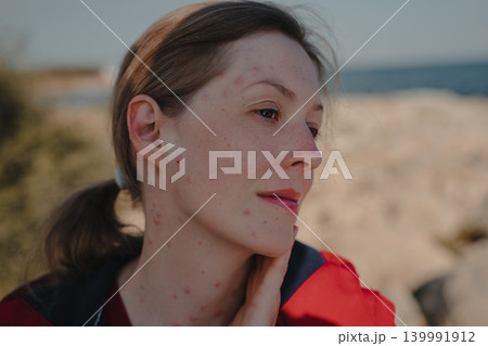 Portrait of a sad woman with chicken pox on the seashore Portrait of a sad woman with chicken pox on the seashore 139991912