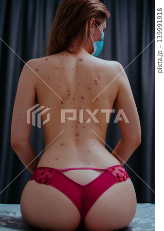Sexy woman with chickenpox wearing medical mask in the bedroom Sexy woman with chickenpox wearing medical mask in the bedroom 139991918
