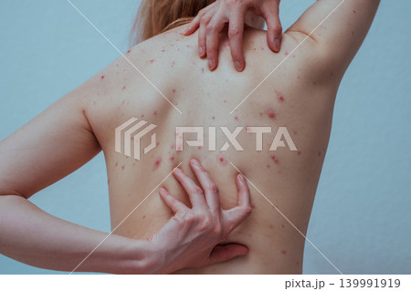 A woman with chicken pox scratches her back A woman with chicken pox scratches her back 139991919