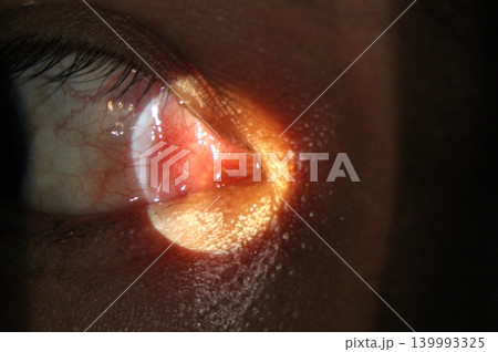 Close-up photograph of the medial canthus demonstrating inflammation of the lacrimal caruncle with focal hyperemia and swelling Close-up photograph of the medial canthus demonstrating inflammation of the lacrimal caruncle with focal hyperemia and swelling 139993325