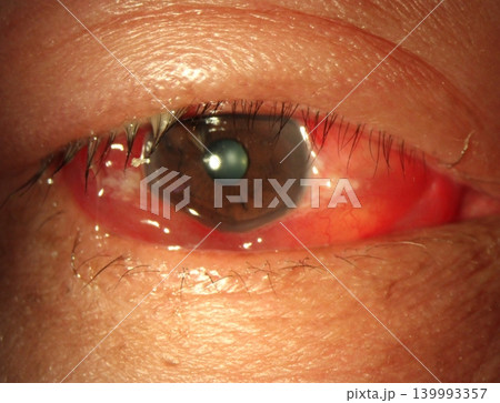Slit-lamp photograph showing conjunctival edema (chemosis) associated with allergic conjunctivitis 139993357