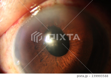 Close-up of an eye with displaced pupil Close-up of an eye with displaced pupil 139993588