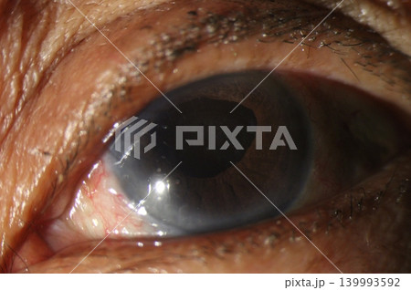 Macro anterior segment image of an eye with displaced pupil after intraocular lens implantation 139993592