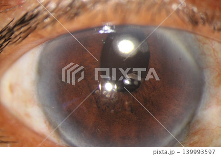 Corectopia. Slit lamp image showing postoperative pupil displacement and oval deformation after ocular surgery Corectopia. Slit lamp image showing postoperative pupil displacement and oval deformation after ocular surgery 139993597
