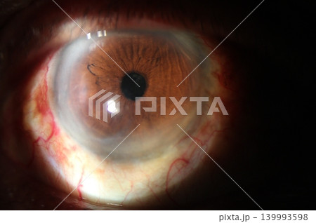 Anterior segment slit-lamp image demonstrating peripheral stromal edema and endothelial fold lines 139993598