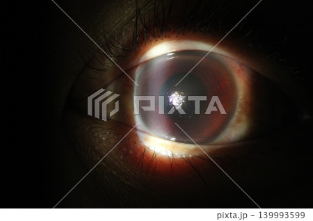 Clinical slit-lamp photo revealing diffuse corneal edema associated with blood staining Clinical slit-lamp photo revealing diffuse corneal edema associated with blood staining 139993599