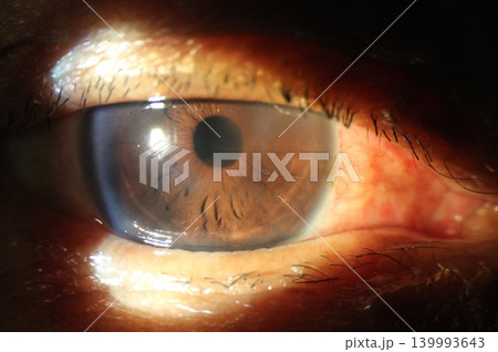 High-resolution anterior segment close-up displaying corneal edema and mild clouding High-resolution anterior segment close-up displaying corneal edema and mild clouding 139993643