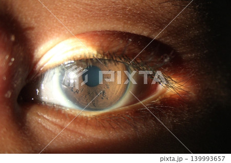 Detailed slit lamp view highlighting iris crypts on the anterior iris Detailed slit lamp view highlighting iris crypts on the anterior iris 139993657