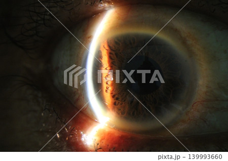 Multiple iris crypts in the anterior segment observed under slit beam illumination Multiple iris crypts in the anterior segment observed under slit beam illumination 139993660