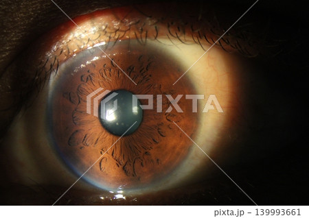 Multiple petal-shaped iris crypts during eye examination Multiple petal-shaped iris crypts during eye examination 139993661
