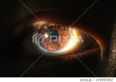 Multiple prominent iris crypts observed on slit-lamp examination Multiple prominent iris crypts observed on slit-lamp examination 139993662
