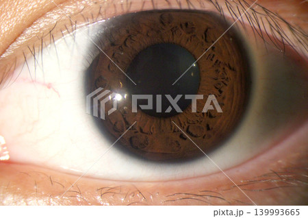 Prominent iris crypts accompanied by multiple radial furrows 139993665