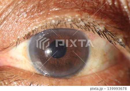 Corneal edema. Slit lamp image showing mild central corneal edema, subtle arcus senilis 139993678