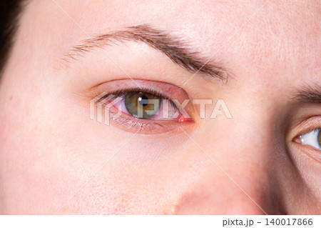 Close up of a young woman red, irritated eye from conjunctivitis. Medical exam needed. Ophthalmologist consultation, eye drops prescription. Vision check urgency for clinic advertising Close up of a young woman red, irritated eye from conjunctivitis. Medical exam needed. Ophthalmologist consultation, eye drops prescription. Vision check urgency for clinic advertising 140017866