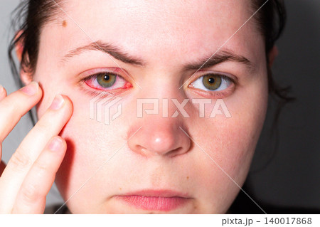 Close up of a young woman red, irritated eye from conjunctivitis. Medical exam needed. Ophthalmologist consultation, eye drops prescription. Vision check urgency for clinic advertising Close up of a young woman red, irritated eye from conjunctivitis. Medical exam needed. Ophthalmologist consultation, eye drops prescription. Vision check urgency for clinic advertising 140017868