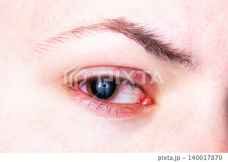 Uncomfortable red eye and enlarged pupil after medicated drops. Allergic or bacterial conjunctivitis. Visual for Ophthalmologist and Professional eye care clinic Uncomfortable red eye and enlarged pupil after medicated drops. Allergic or bacterial conjunctivitis. Visual for Ophthalmologist and Professional eye care clinic 140017870