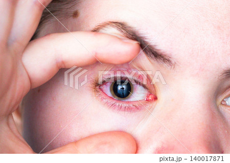 Woman showing red eye and enlarged pupil after ophthalmologist visit. Medical prescription for conjunctivitis treatment. Medical eye test in clinic 140017871