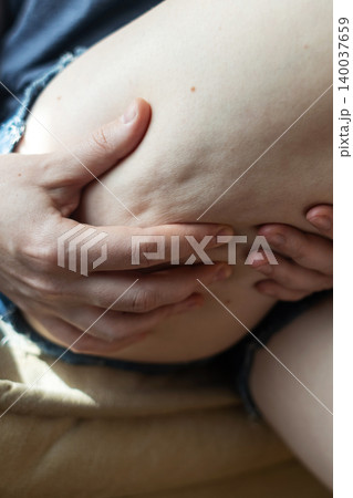 Close-up of a woman squeezing skin on her thigh, showing cellulite texture and orange peel effect. Concept of body aesthetic, female lipodystrophy, skin imperfections, and self-acceptance. Close-up of a woman squeezing skin on her thigh, showing cellulite texture and orange peel effect. Concept of body aesthetic, female lipodystrophy, skin imperfections, and self-acceptance. 140037659