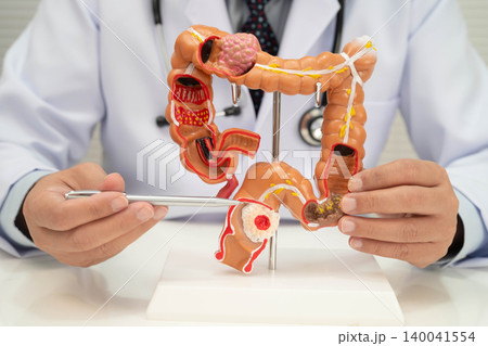 Asian doctor with rectum and hemorrhoid human anatomy model at hospital, inflamed vascular structure. Asian doctor with rectum and hemorrhoid human anatomy model at hospital, inflamed vascular structure. 140041554