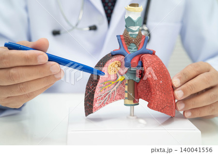 Pneumonia, lung cancer, Asian doctor with human lung model. Pneumonia, lung cancer, Asian doctor with human lung model. 140041556