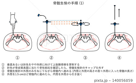骨髄生検の手順 (1) 140056859