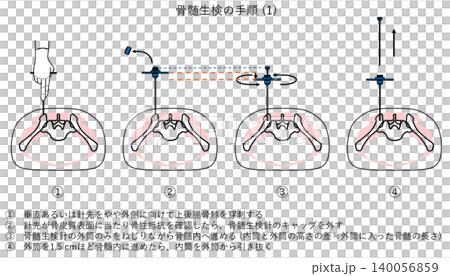 骨髄生検の手順 (1) 140056859