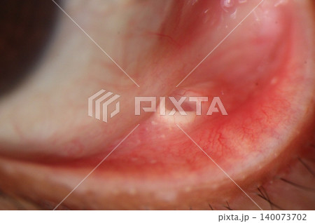 Conjunctival retention cyst. Slit lamp photo of a clear, thin-walled, conjunctival cyst with mild local inflammation on the lower fornix Conjunctival retention cyst. Slit lamp photo of a clear, thin-walled, conjunctival cyst with mild local inflammation on the lower fornix 140073702
