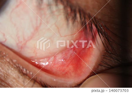 Multiple small conjunctival cysts associated with conjunctival hyperemia Multiple small conjunctival cysts associated with conjunctival hyperemia 140073703