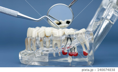 Dental checkup concept. Dentist using a mirror and explorer to examine a transparent anatomical jaw model showing deep cavities, root canals, and cysts. 140074838