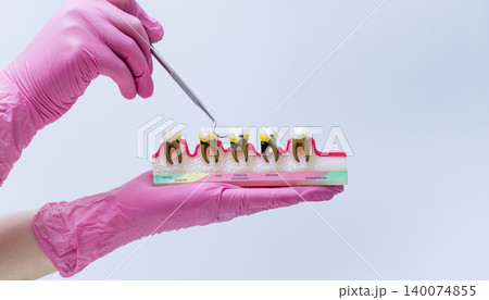 Dentist holding a periodontal disease model. Stages of gingivitis, periodontitis, and bone loss anatomy concept. 140074855