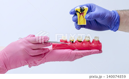 Dentists holding educational models showing external cavities and a cross-section of severe deep decay reaching the pulp. Pulpitis concept. Dentists holding educational models showing external cavities and a cross-section of severe deep decay reaching the pulp. Pulpitis concept. 140074859