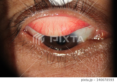 Slit lamp image of upper lid eversion with Q-tip showing hyperemic palpebral conjunctiva Slit lamp image of upper lid eversion with Q-tip showing hyperemic palpebral conjunctiva 140078593