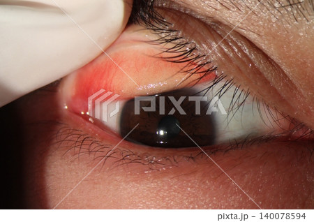 Slit lamp image showing eyelid eversion with conjunctival hyperemia and papillae Slit lamp image showing eyelid eversion with conjunctival hyperemia and papillae 140078594