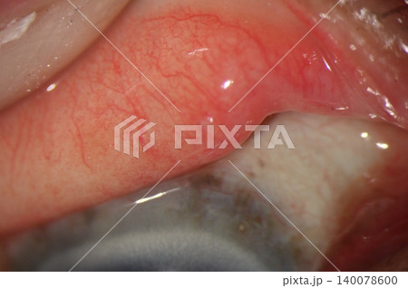 Upper eyelid eversion demonstrating a pair of inflamed nodular lesions Upper eyelid eversion demonstrating a pair of inflamed nodular lesions 140078600